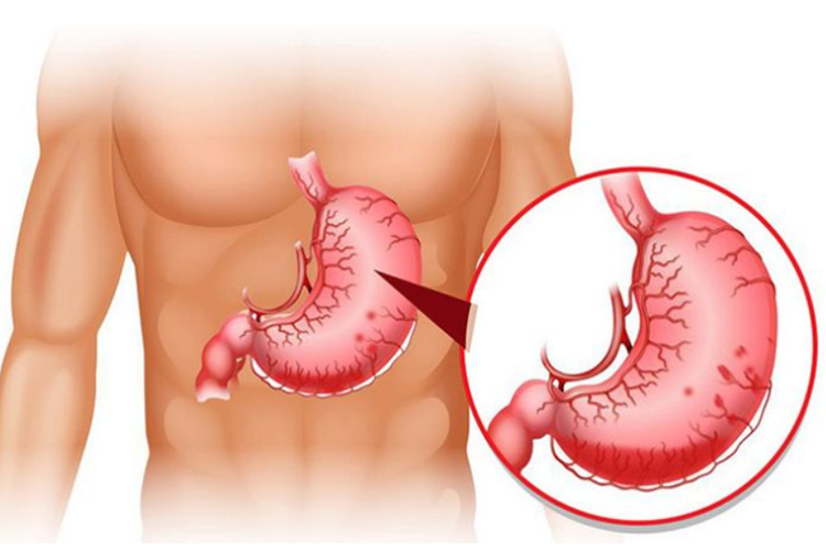 Đau dạ dày: Nguyên nhân, triệu chứng và các phương pháp điều trị